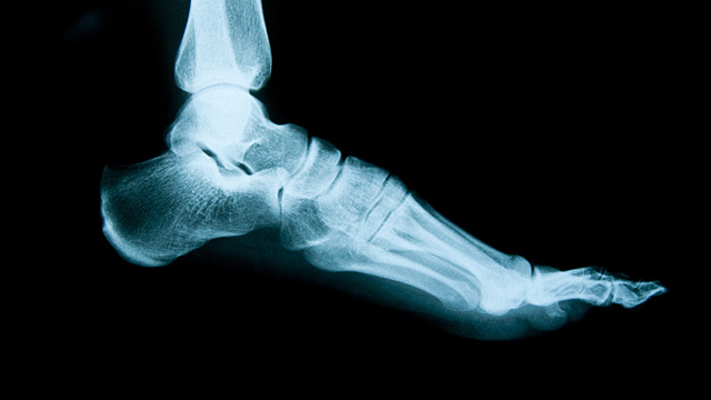 Geballte Füße – der Hallux Valgus